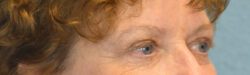 Blepharoplasty