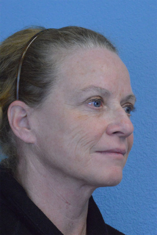 Blepharoplasty Case 157 After Photo Blepharoplasty
