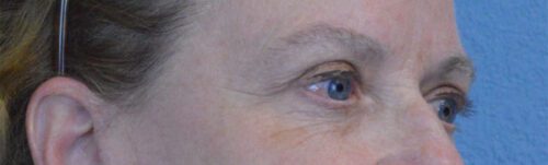 Blepharoplasty