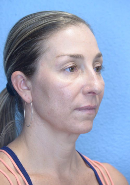 Cheek Augmentation