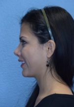 Chin Augmentation