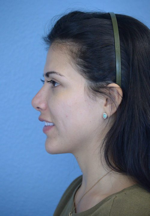 Chin Augmentation