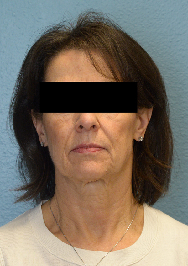 Laser Resurfacing Treament with Fractional CO2 Laser Results Reno