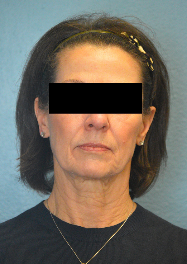 Laser Resurfacing Treament with Fractional CO2 Laser Results Reno