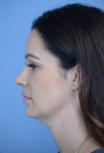 Kybella