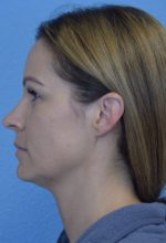 Kybella
