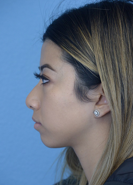 Chin Augmentation