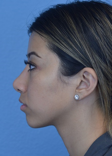 Chin Augmentation