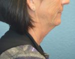 Face and Neck Lift