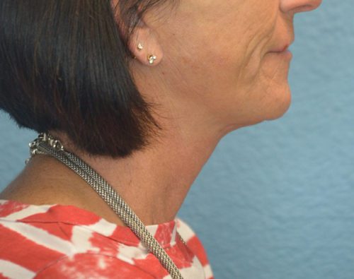 Face and Neck Lift