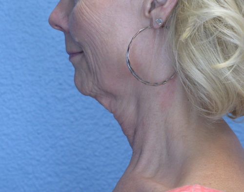 Face Lift and Neck Lift Results Reno