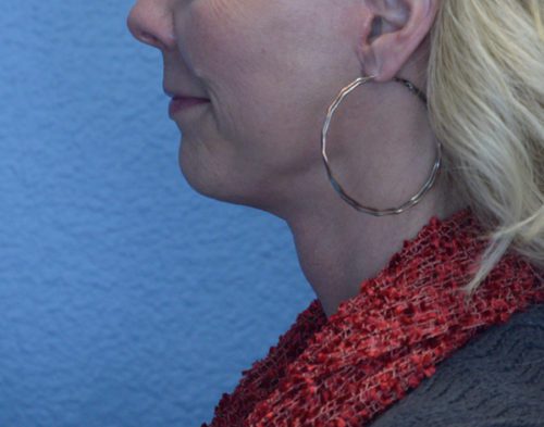 Face Lift and Neck Lift Results Reno