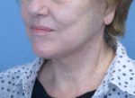 Face and Neck Lift