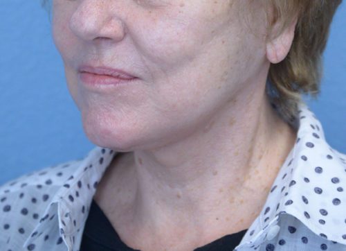 Face and Neck Lift