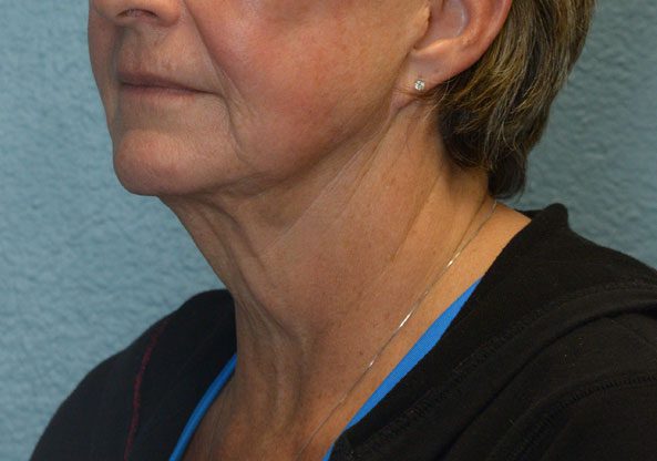 Face and Neck Lift