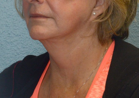 Face and Neck Lift