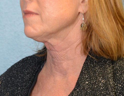 Face and Neck Lift