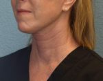 Face and Neck Lift