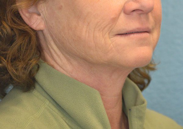 Face and Neck Lift