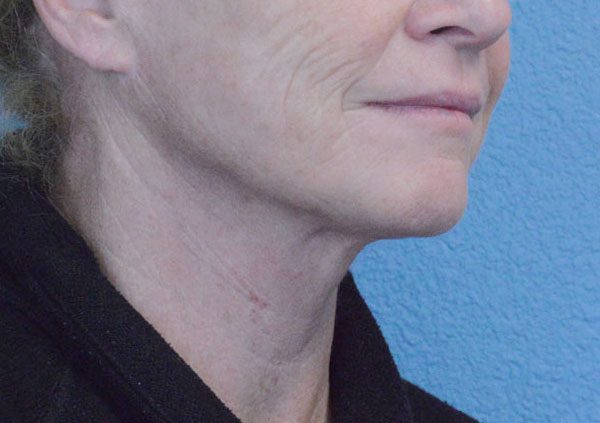 Face and Neck Lift