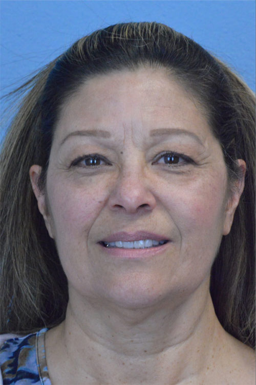 Blepharoplasty Case 798 Before Photo Blepharoplasty