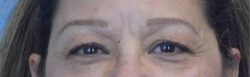 Blepharoplasty