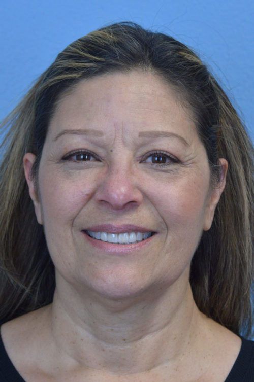 Blepharoplasty Case 798 After Photo Blepharoplasty