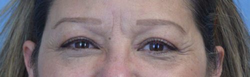 Blepharoplasty