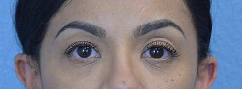 Blepharoplasty