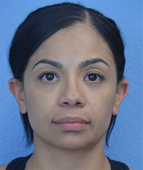 Blepharoplasty Case 737 Before Photo Blepharoplasty