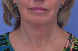 Face and Neck Lift