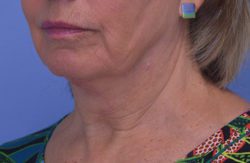 Face and Neck Lift