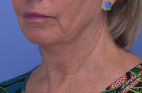 Face and Neck Lift