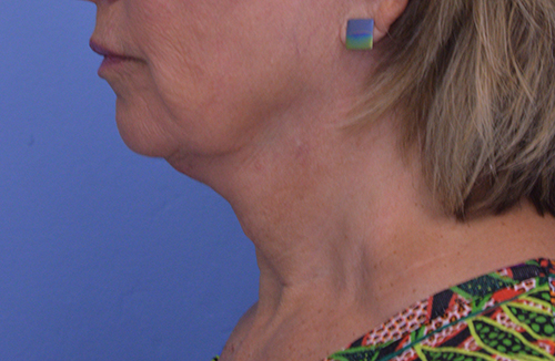 Face and Neck Lift