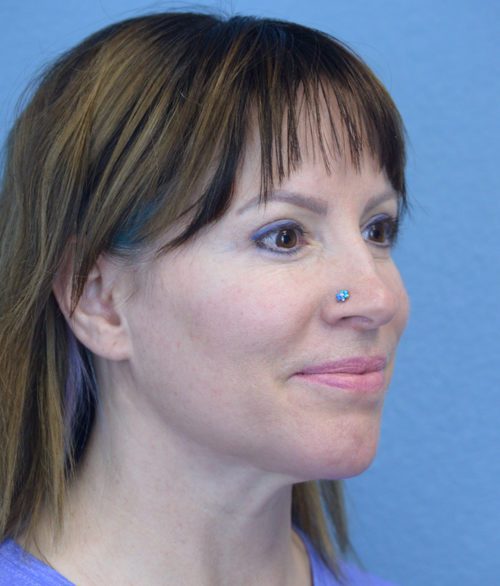 Chin Augmentation