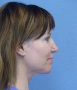 Chin Augmentation