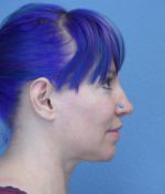 Chin Augmentation