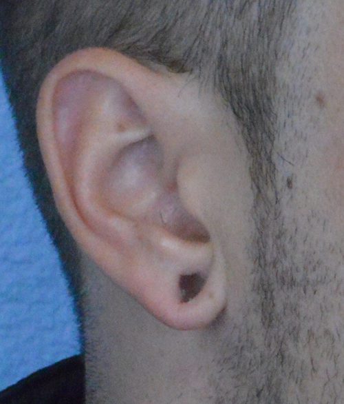Ear Lobe Repair Case 639 Before Photo Ear Lobe Repair