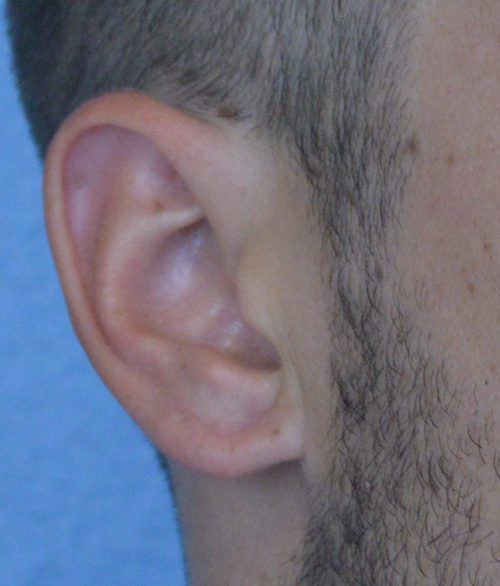 Ear Lobe Repair Case 639 After Photo Ear Lobe Repair