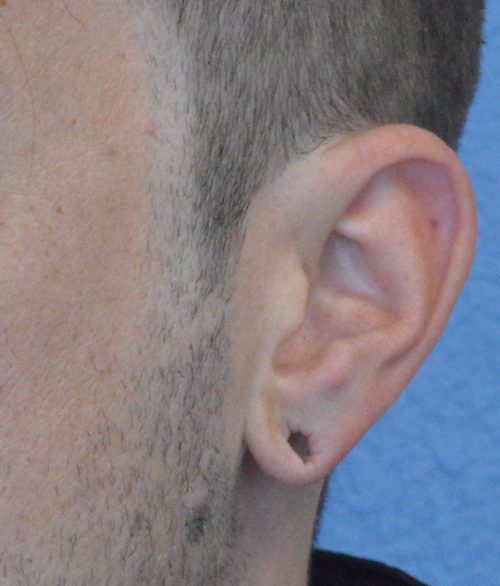 Ear Lobe Repair Case 639 Before Photo Ear Lobe Repair