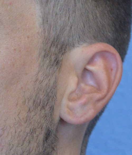 Ear Lobe Repair Case 639 After Photo Ear Lobe Repair