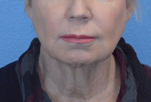 Face and Neck Lift