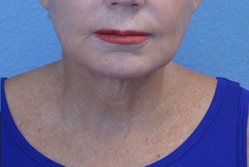 Face and Neck Lift