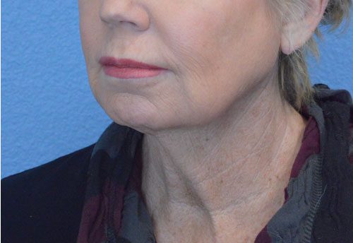 Face and Neck Lift