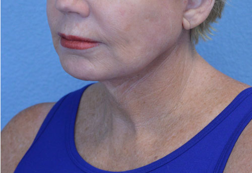 Mini-Facelift Before & After