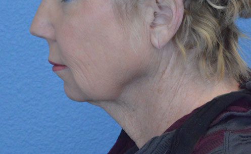 Face and Neck Lift