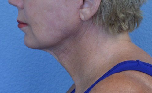 Face and Neck Lift