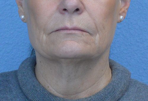 Face and Neck Lift