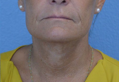 Face and Neck Lift