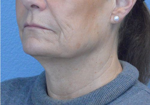 Face and Neck Lift